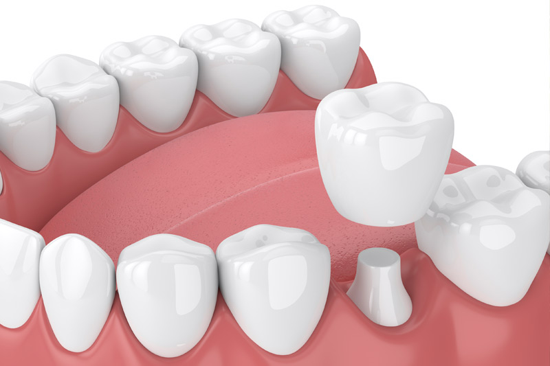 Dental Crowns in Tucson