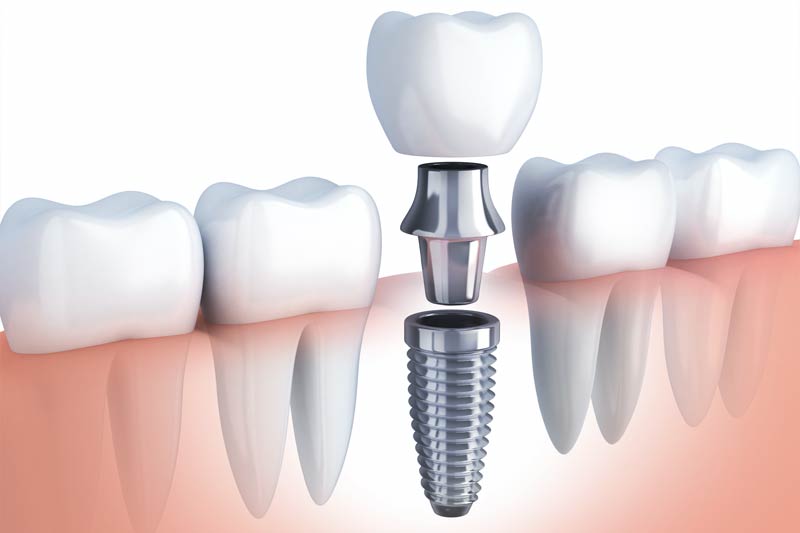 Implants Dentist in Tucson