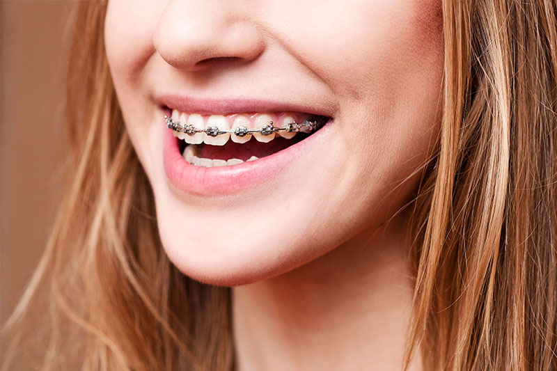 Orthodontics in Tucson