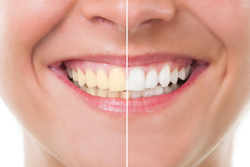 Teeth Whitening in Tucson