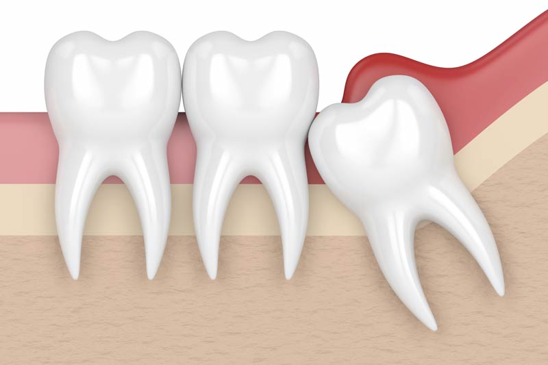 Wisdom Tooth Removal in Tucson